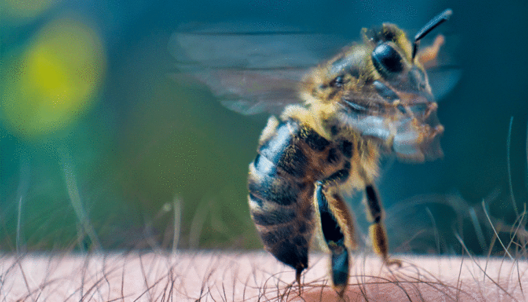 bee-stinging-human
